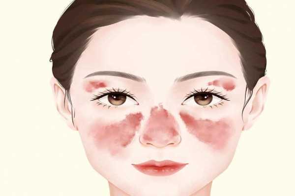 红斑狼疮会传染吗？ 红斑狼疮会不会传染