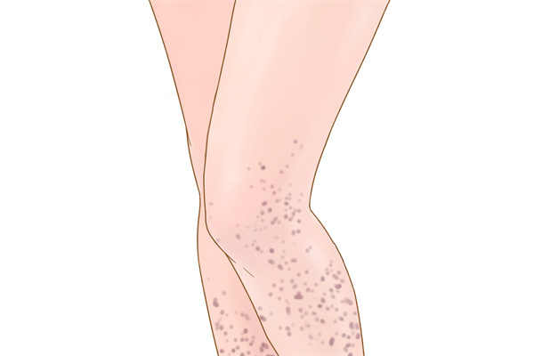 红斑狼疮早期症状 红斑狼疮的早期表现