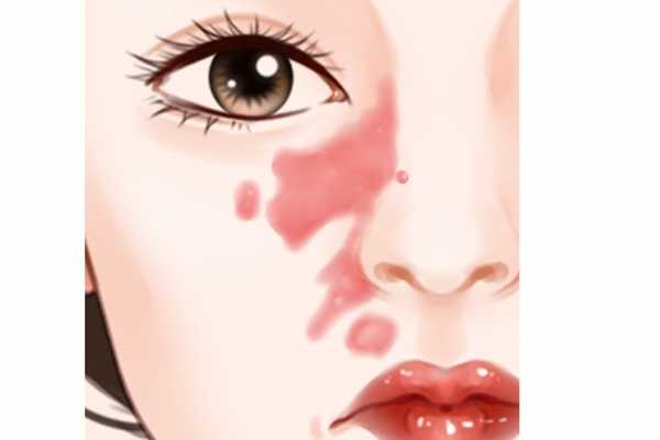 红斑狼疮早期症状 红斑狼疮的早期表现