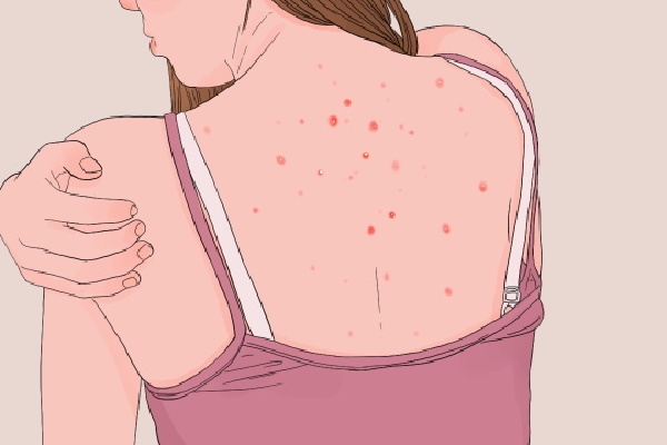 三伏天吃什么祛湿气快 三伏天怎么排湿气寒气