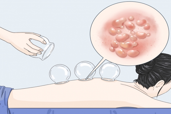 三伏天刮痧拔罐的好处和坏处 拔罐和刮痧哪个去湿气