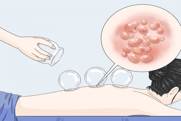 三伏天中午可以拔火罐吗？ 三伏天拔罐的最佳时间