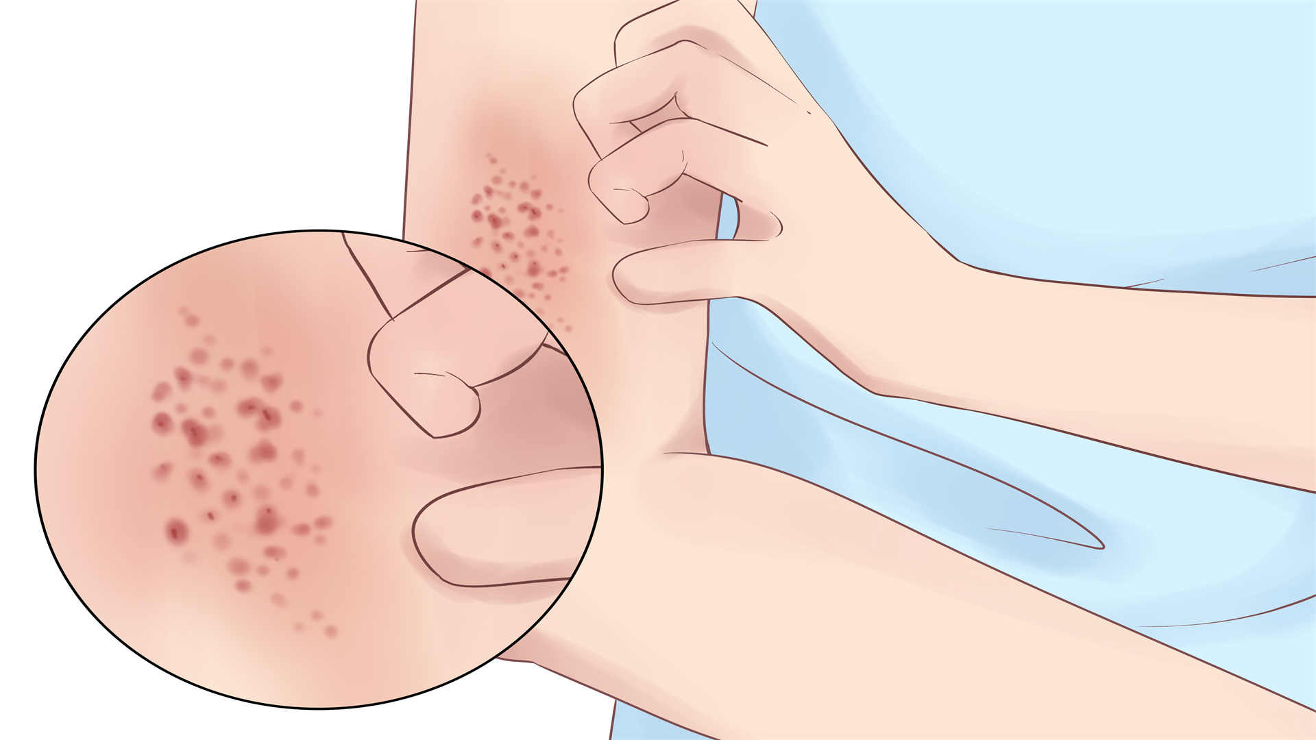 夏天床上有红色的小虫怎么办 红色小虫的应对措施