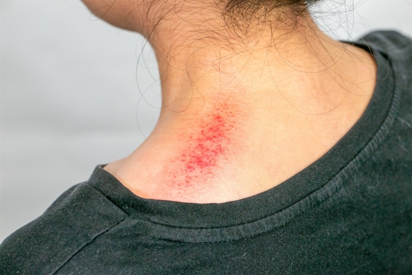 湿气重拔罐还是刮痧好 刮痧怎么看出湿气重