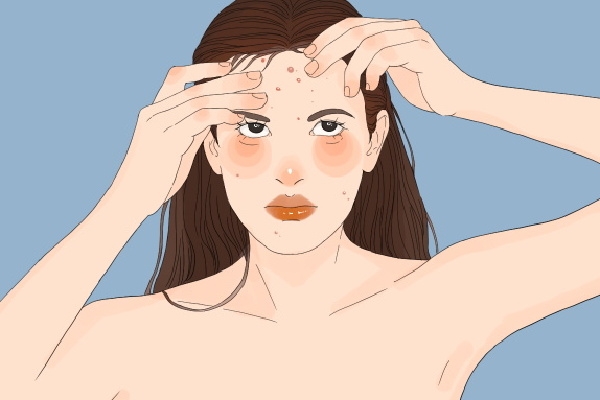 上火长痘痘怎么调理去火 上火冒痘吃什么降火