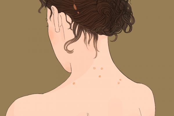 上火长痘痘怎么调理去火 上火冒痘吃什么降火