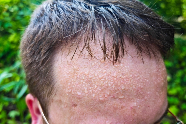 肝火旺可以汗蒸出汗吗？ 一动就出汗跟肝火旺有关系吗？