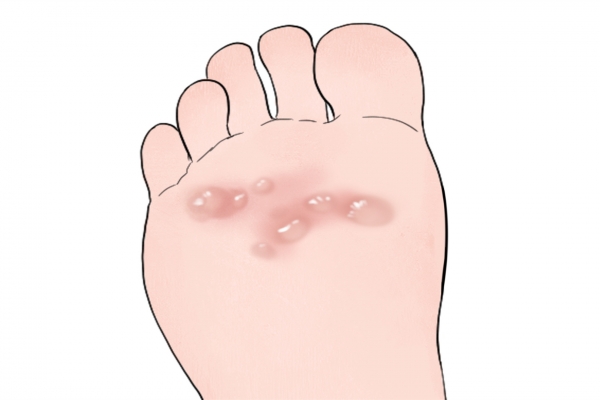 脚上长水泡是湿气重吗？ 出水泡是排湿现象吗？