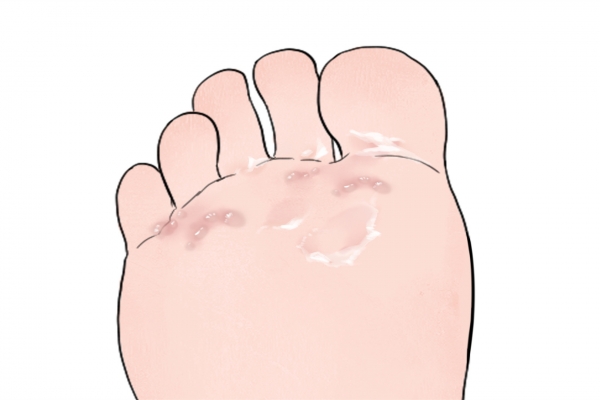 脚上长水泡是湿气重吗？ 出水泡是排湿现象吗？