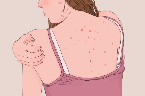 身体湿气太重有什么危害 身体湿气太重是什么原因造成的