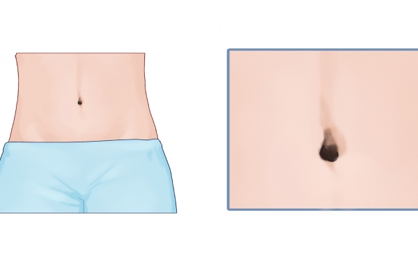 肚脐眼是什么穴位 什么是神阙穴