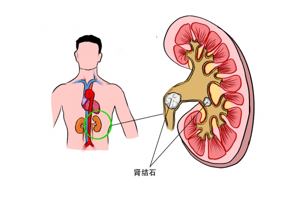 肾结石不能吃什么 肾结石患者的食疗方法