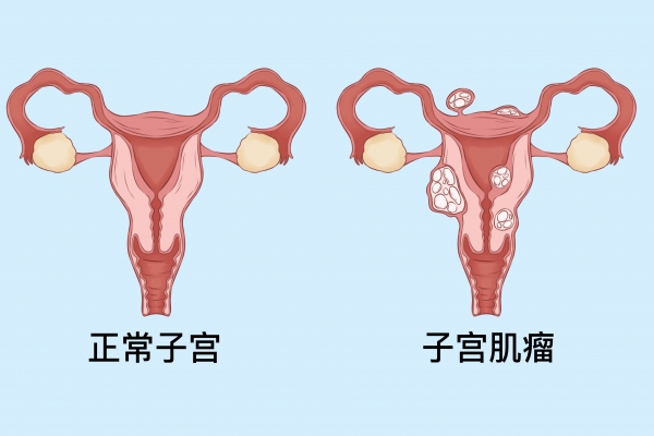 子宫肌瘤不能吃什么 子宫肌瘤患者饮食原则