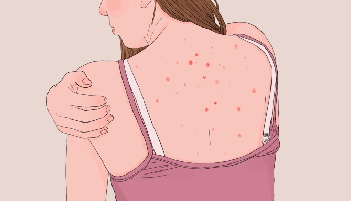 去除体内湿气的穴位 体内湿气重怎么办