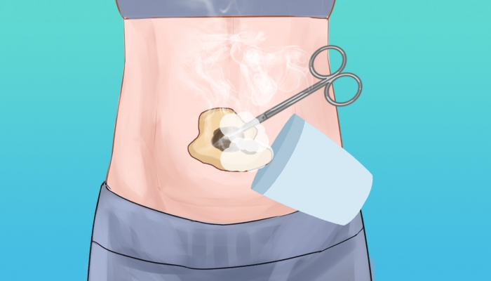 来月经可以艾灸肚子吗？ 例假期艾灸会不会止血