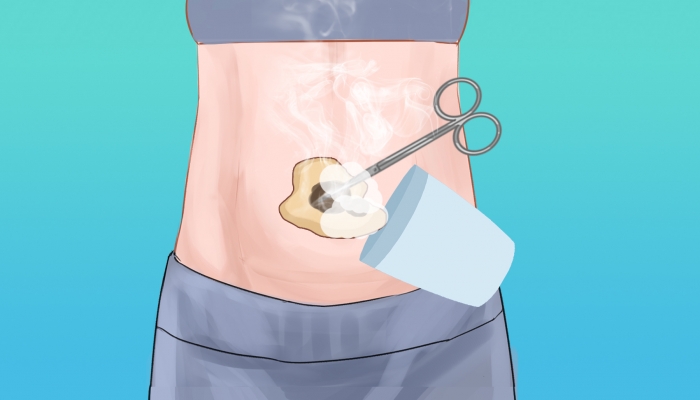 寒露艾灸选陈年艾条更利养生吗？ 如何挑选陈年艾条